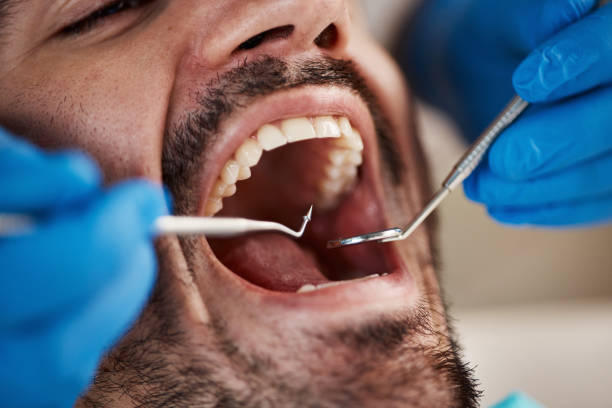 Best Chipped Tooth Repair Near Me  in Wichita Falls, TX